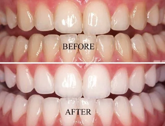 Can a Professional Dental Cleaning Safely Brighten Your Teeth?