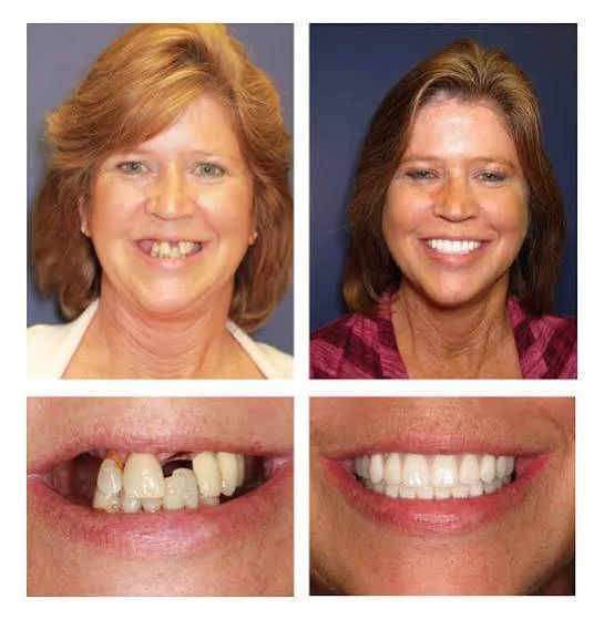 Questions to Ask Your Dental Implant Dentist